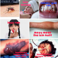 Semana Oin, Governu Sei Aprezenta Kestaun Dengue iha PN